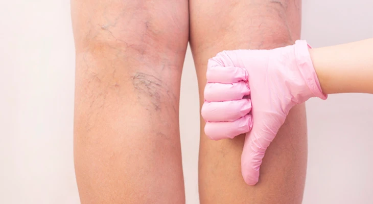 Сахарный диабет и венозные осложнения