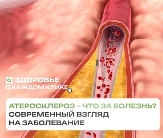 Атеросклероз – что это за болезнь?