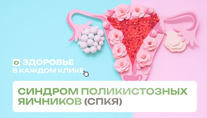 Синдром поликистозных яичников (СПКЯ)