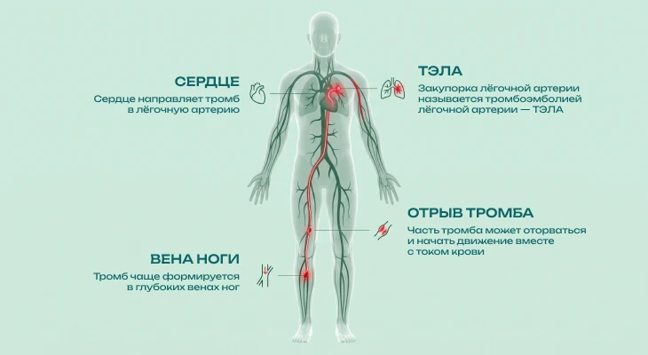 Триада Вирхова: ключевой механизм развития тромбоза